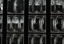 cbd for sciatica relief