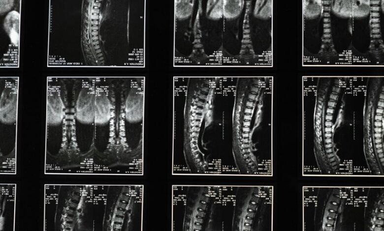 cbd for sciatica relief
